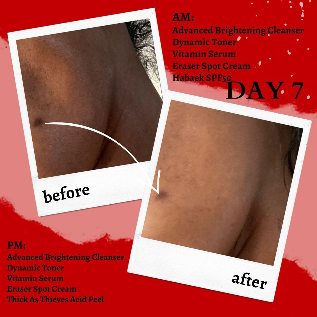 Extreme Glycolic & Lactic Acid Gel Peel, Clinical Exfoliation