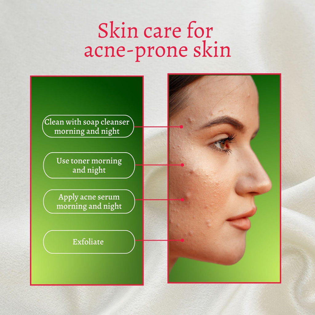 Perfect Trifecta Acne Peel - Glycolic & Lactic Acid Exfoliant
