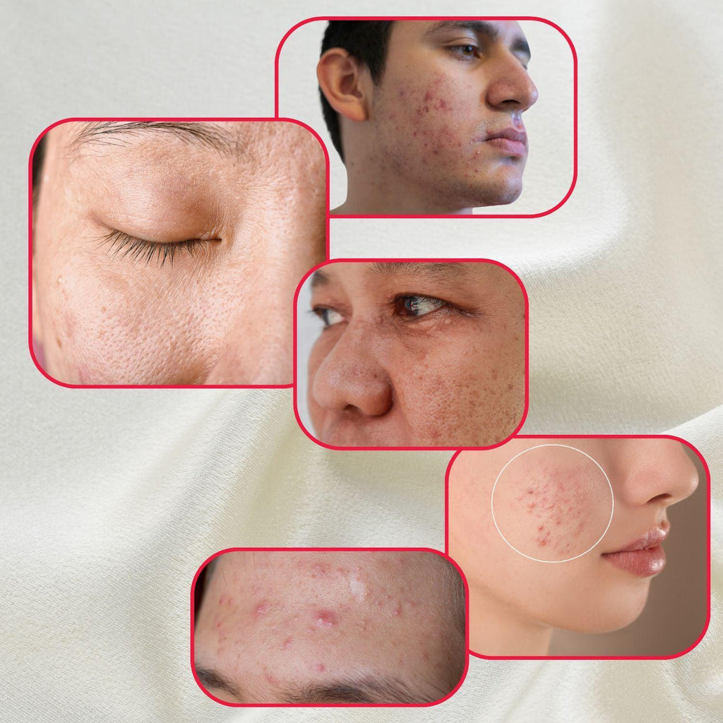 Perfect Trifecta Acne Peel - Glycolic & Lactic Acid Exfoliant