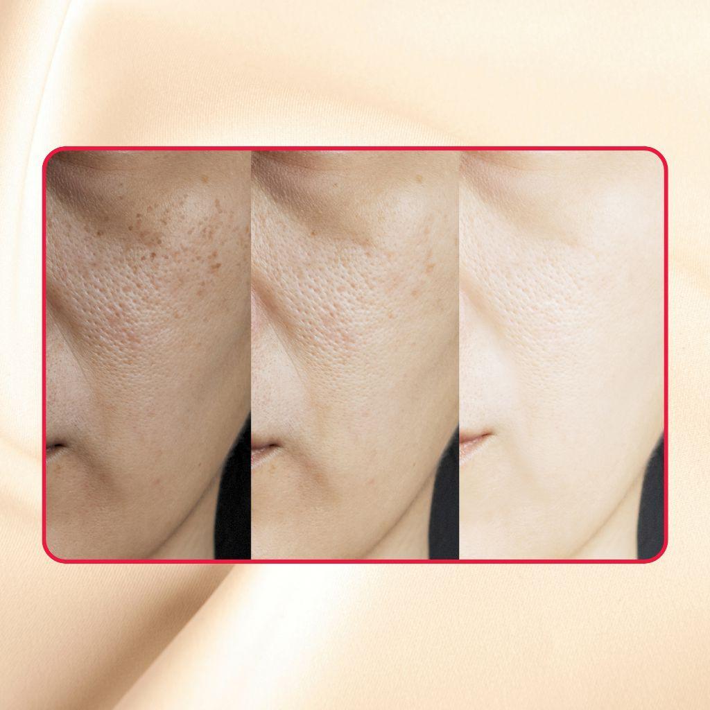 High-Strength Glycolic and Lactic Acid 30% Extreme Gel Peel