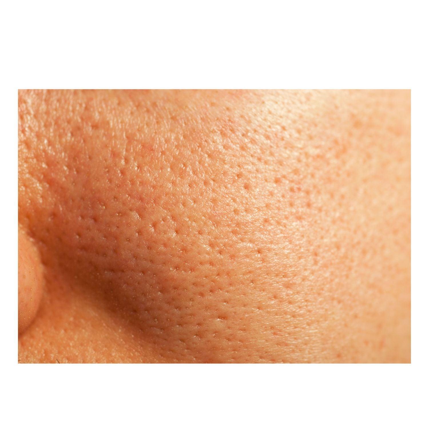 Extreme Glycolic & Lactic Acid Gel Peel, Clinical Exfoliation