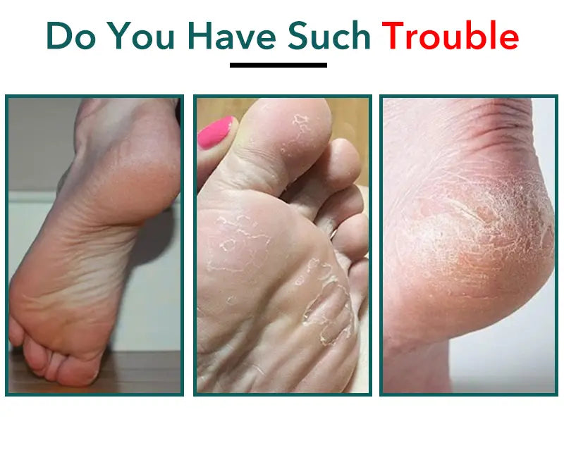Stainless Steel Callus Remover