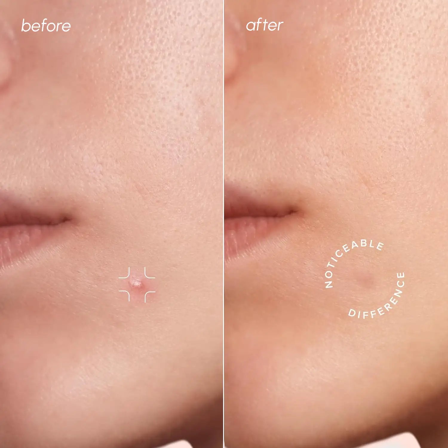 Invisible Hydrocolloid Pimple Patches with Salicylic Acid 72 Count - Image 2