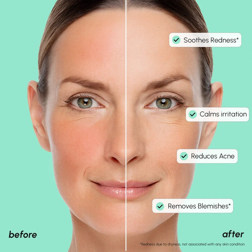 10% Azelaic Acid Face Serum for Redness Relief and Acne Care - Image 4