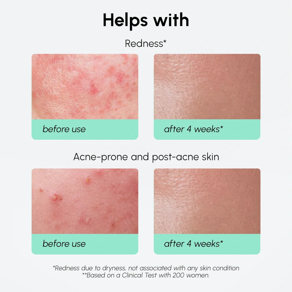 10% Azelaic Acid Face Serum for Redness Relief and Acne Care - Image 5