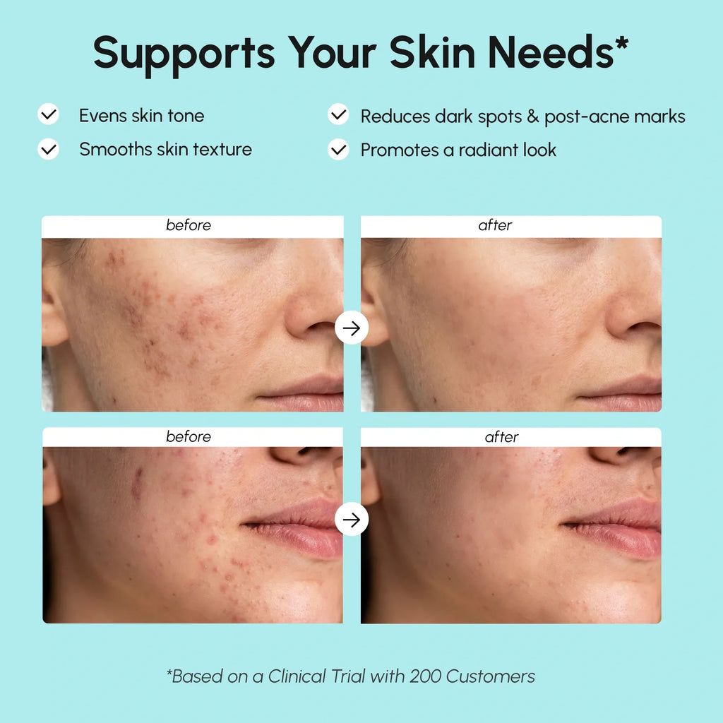 15% Azelaic Acid Face Cream for Blemishes and Dark Spots - Image 3