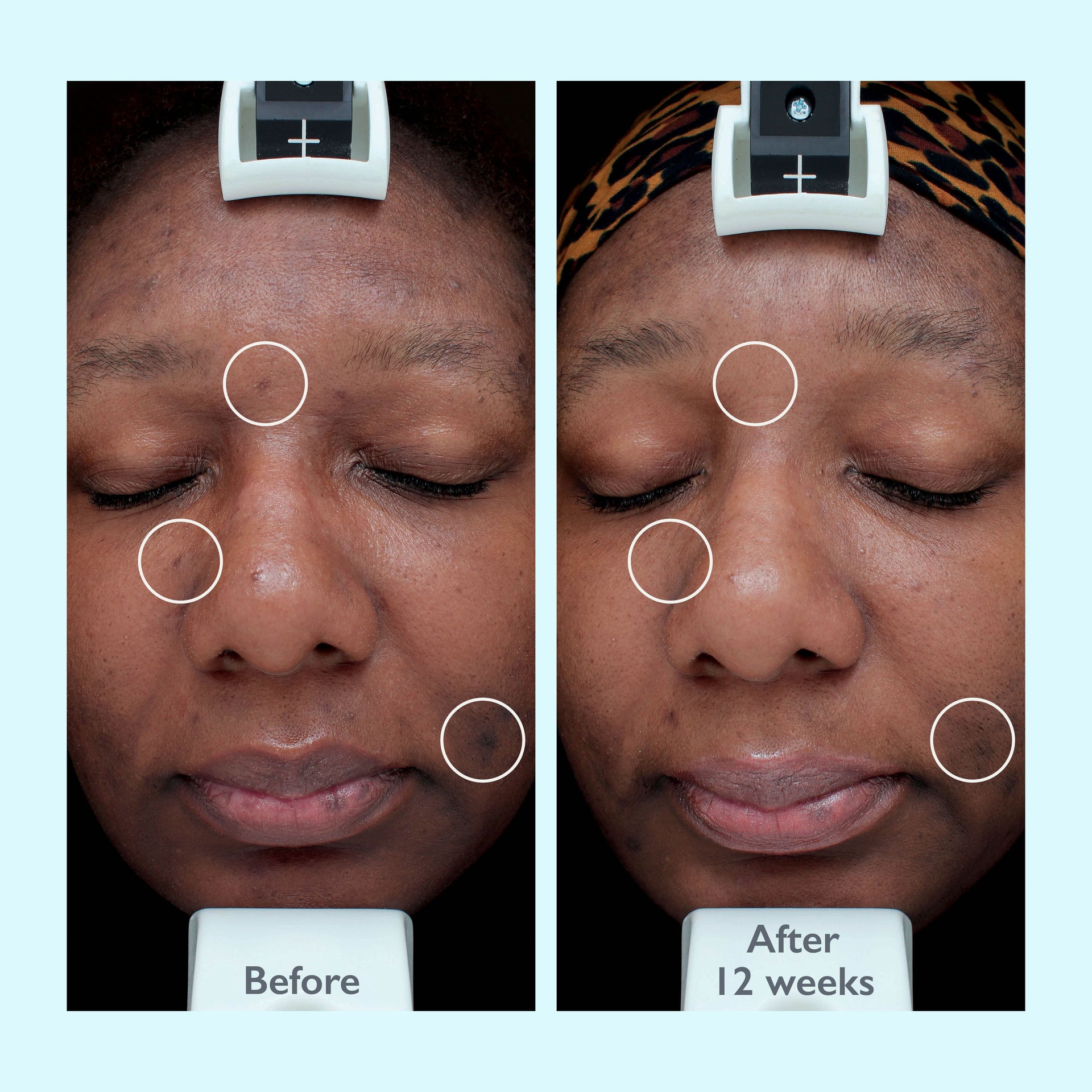 Intensive Treatment 10x Face Serum for Dark Spots and Brightening