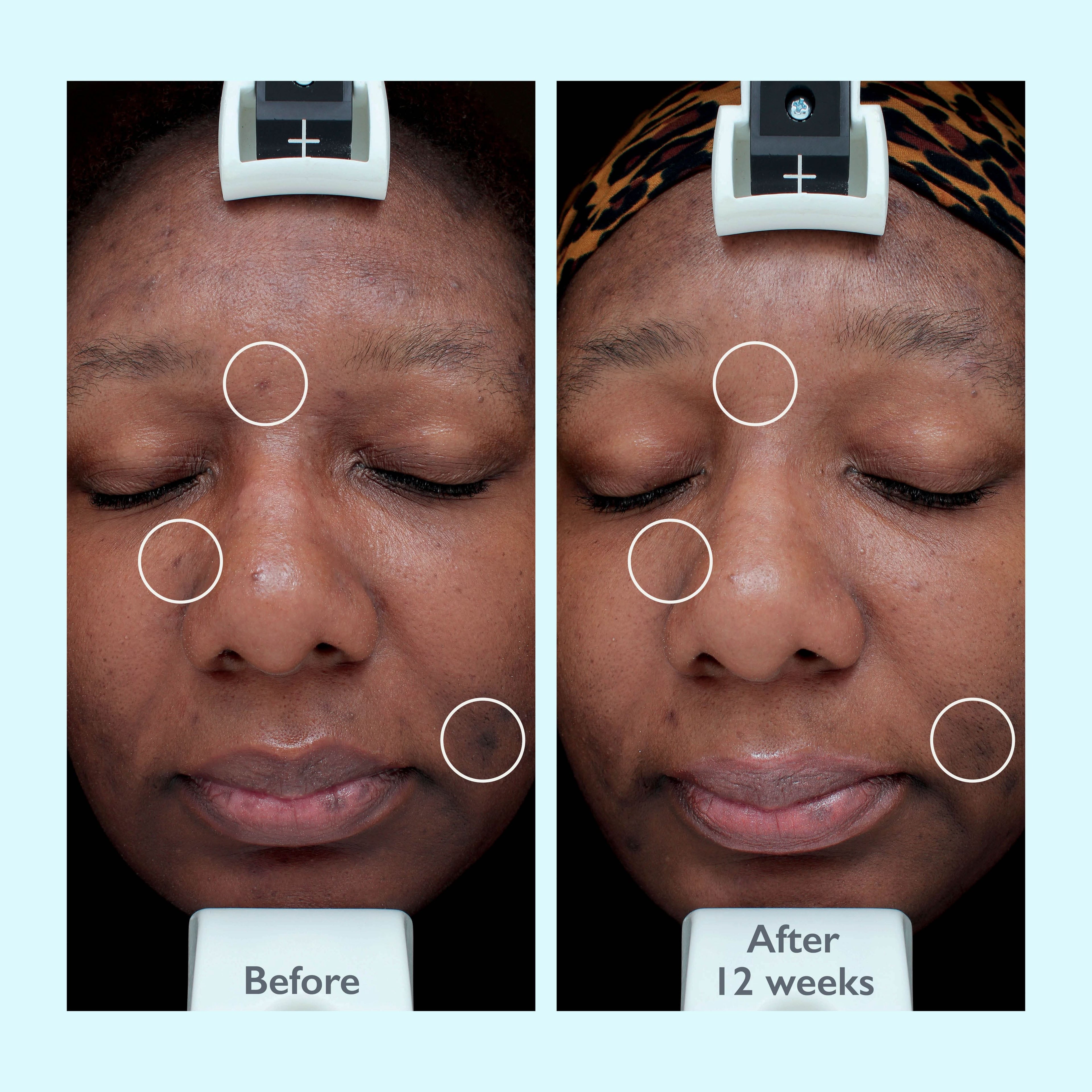 Intensive Treatment 10x Face Serum for Dark Spots and Brightening