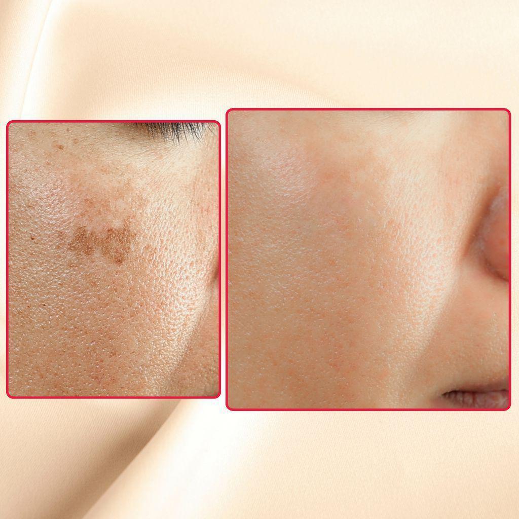 Dark Spot Corrector and Melasma Fade Cream