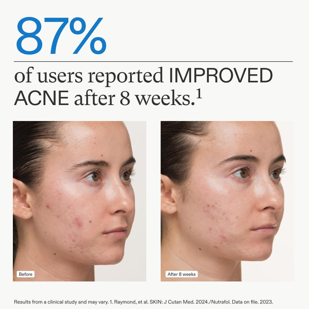 Clear Skin Nutraceutical Acne Supplement for Women - 3-Month Supply