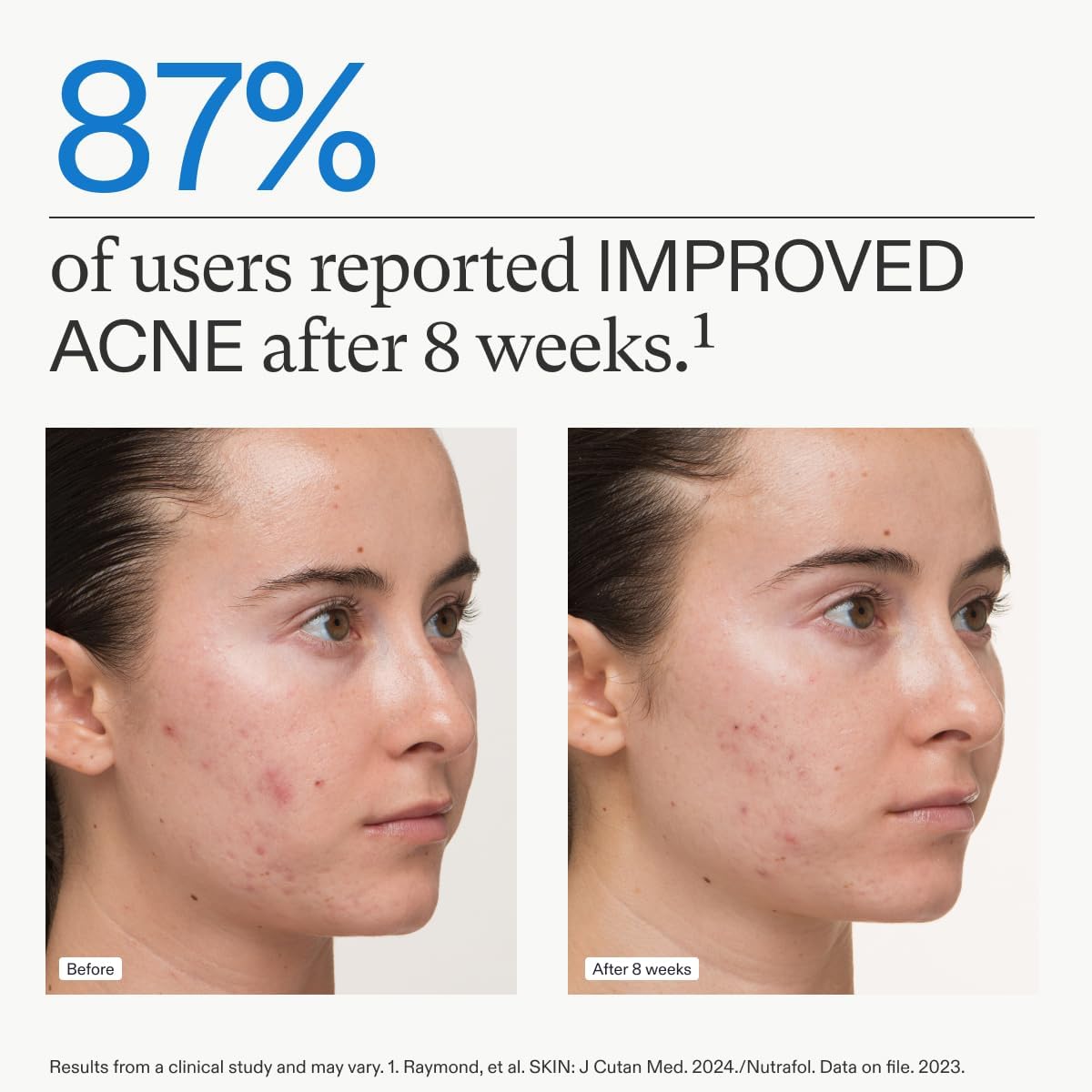 Clear Skin Nutraceutical Acne Supplement for Women - 3-Month Supply